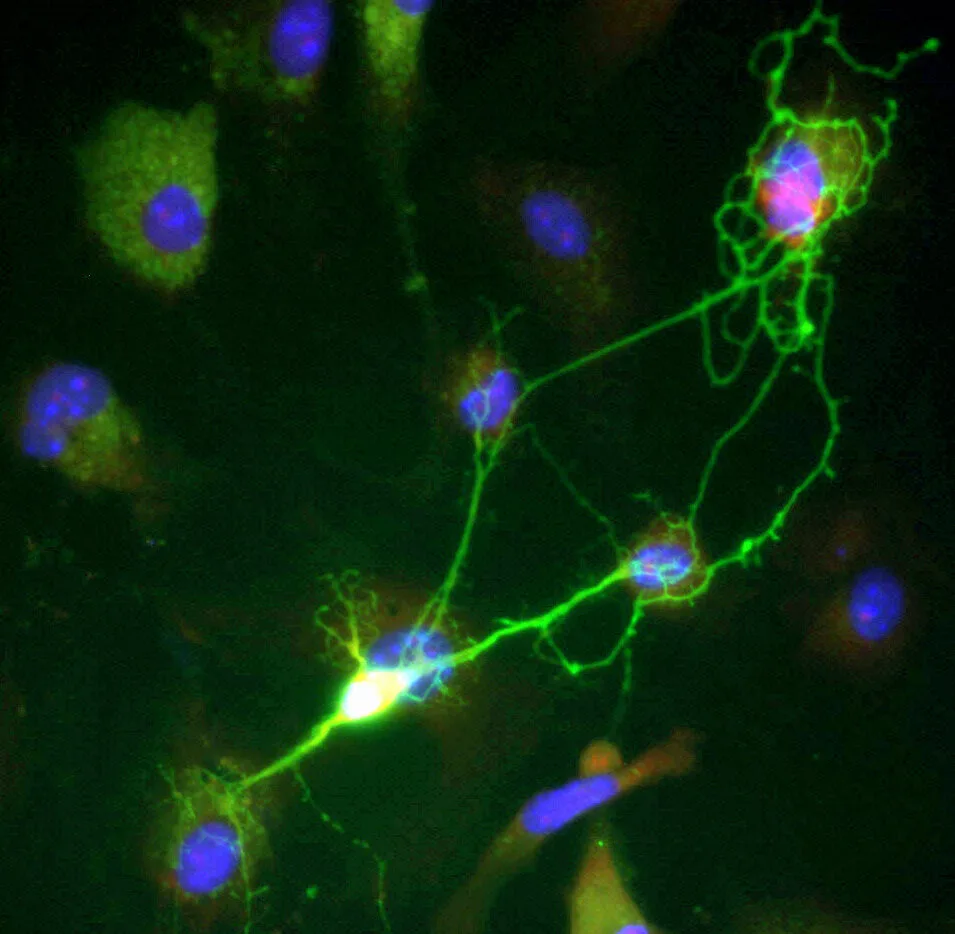 Belirli bir proteinin neuroHIV'de beyin hasarına rol oynayabileceği öne sürülüyor