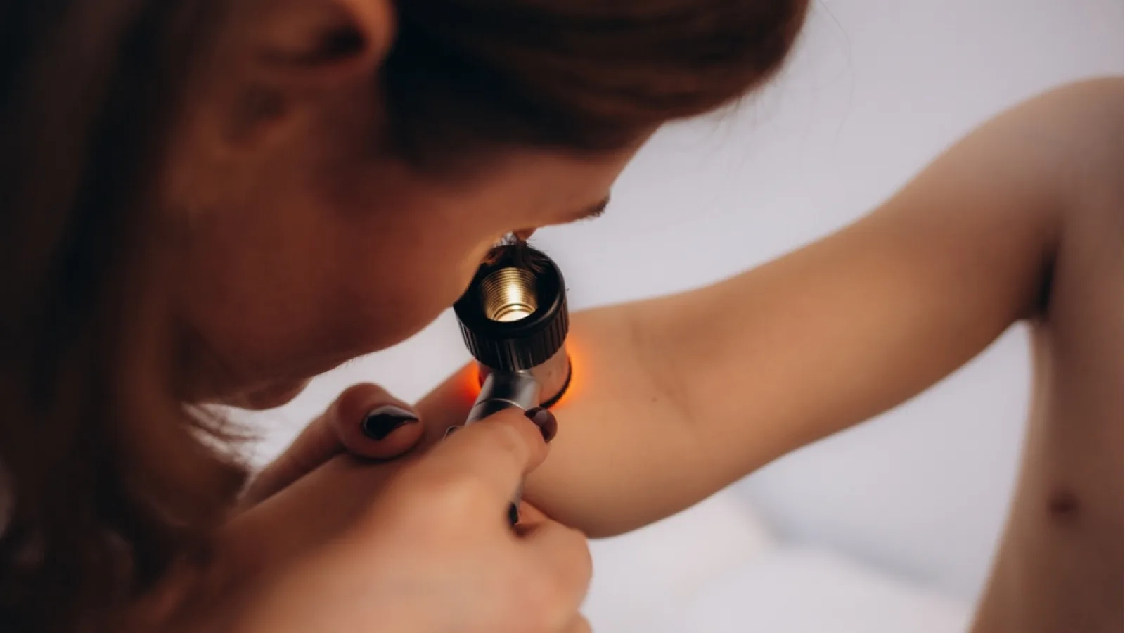 Yaz tatili dönüşü çocuklarda molluscum contagiosum riski artıyor