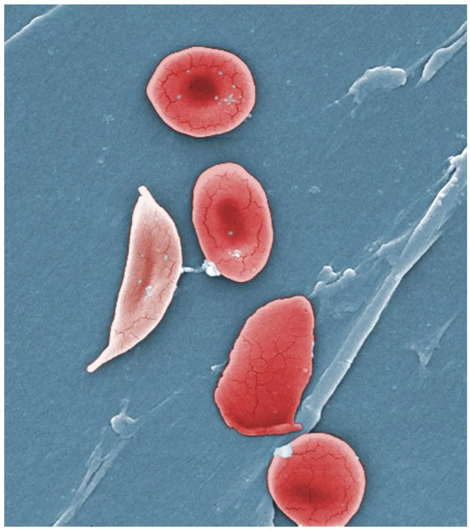 Sickle cell ağrısı, daha önce tanınmayan biyolojik yolları içerebilir