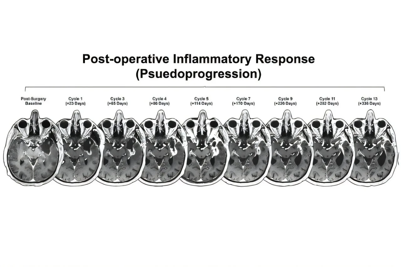 Glioblastoma için immünoterapi etkili olmasında yeni ipuçları tespit edildi