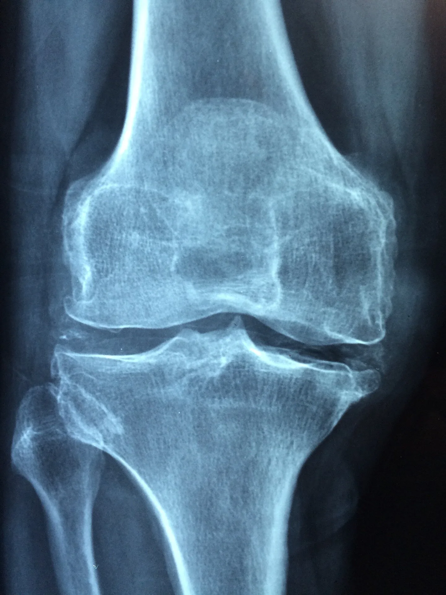 FDA Kararı Osteoporoz İlaç Geliştirmeyi Hızlandırıyor
