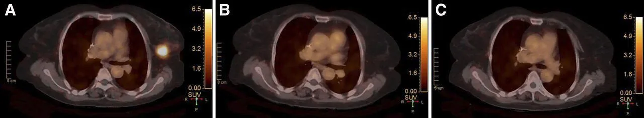 HER2-pozitif meme kanseri tedavisinde ⁶⁸Ga-HER2 PET/CT ile erken yanıt değerlendirmesi gösteriyor